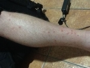 Mosquito Ravaged Legs